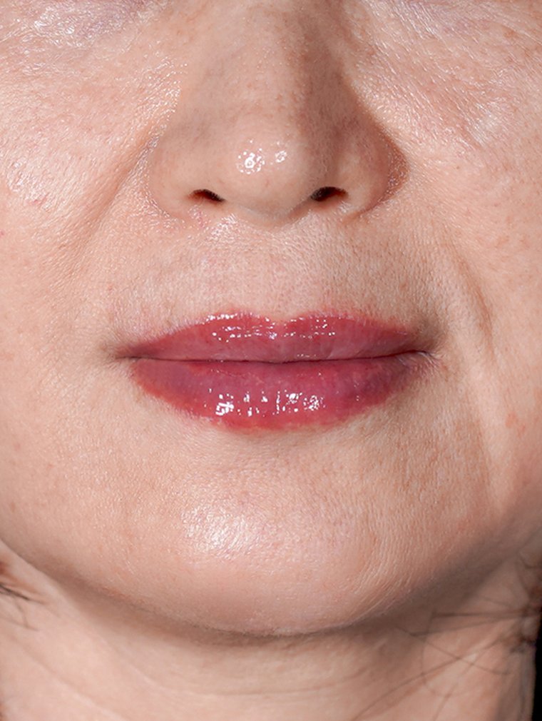 Juvéderm at MILI Clinic Dosan — after, case 1