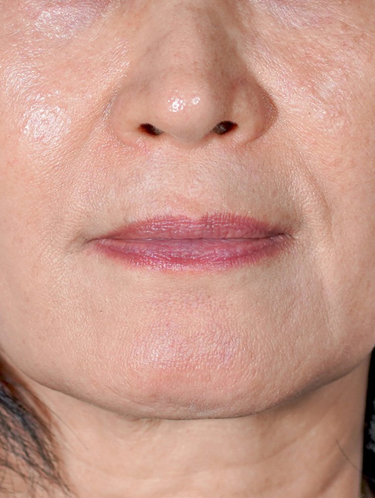 Juvéderm at MILI Clinic Dosan — before, case 1