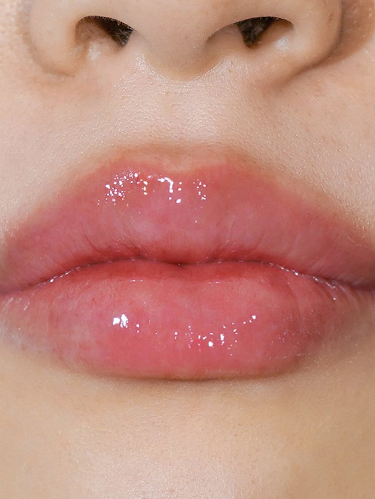 Juvéderm at MILI Clinic Dosan — after, case 2