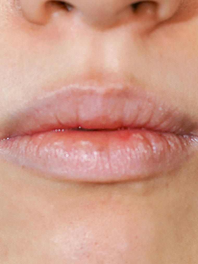 Juvéderm at MILI Clinic Dosan — before, case 2