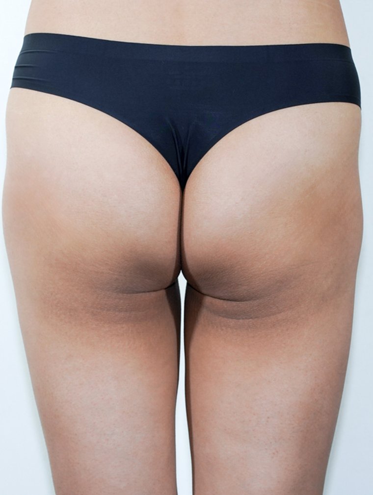 Fit-Sculptra (Body) at MILI Clinic Dosan — before, case 7