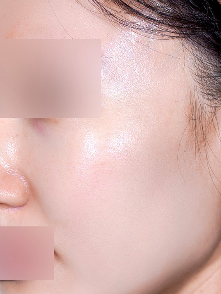 Derma Renewal at MILI Clinic Dosan — after, case 1