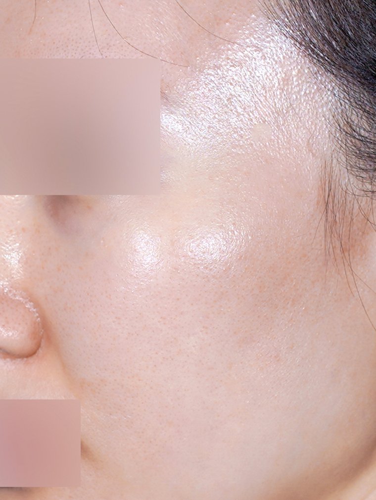 Derma Renewal at MILI Clinic Dosan — before, case 1