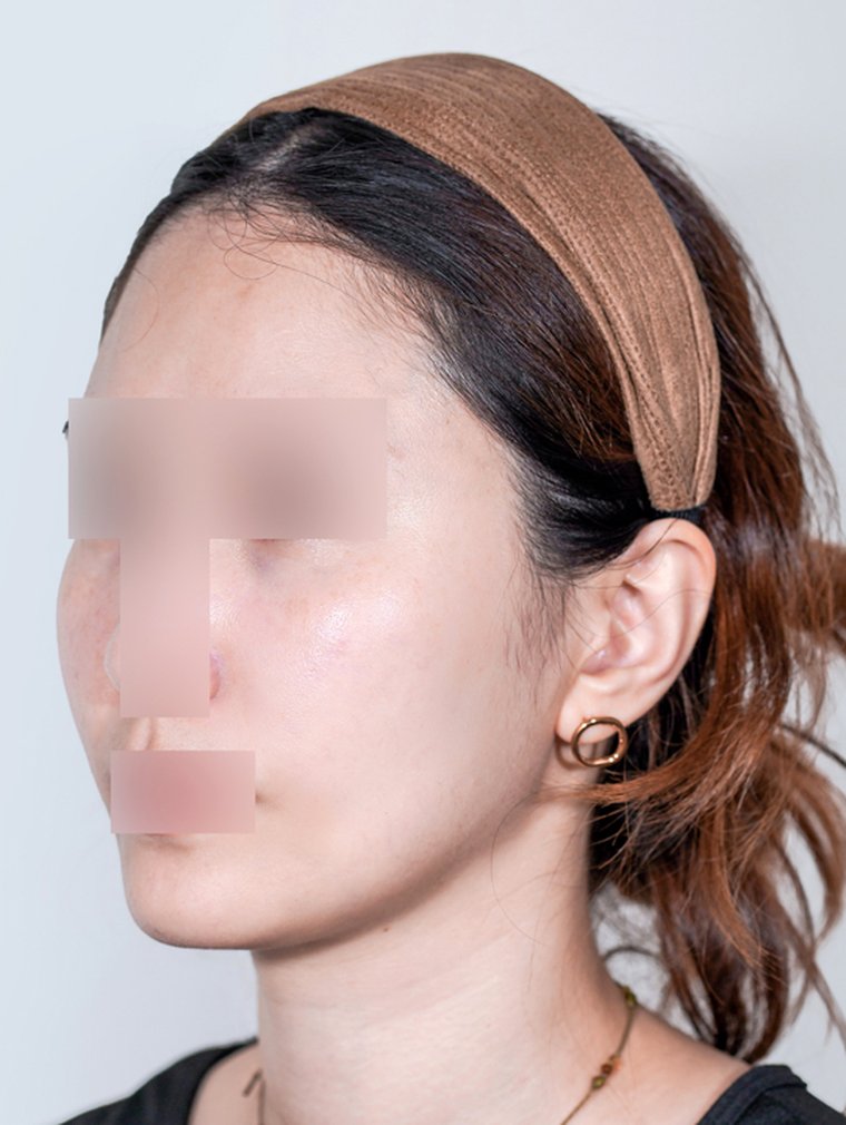 Sculptra at MILI Clinic Dosan — after, case 1