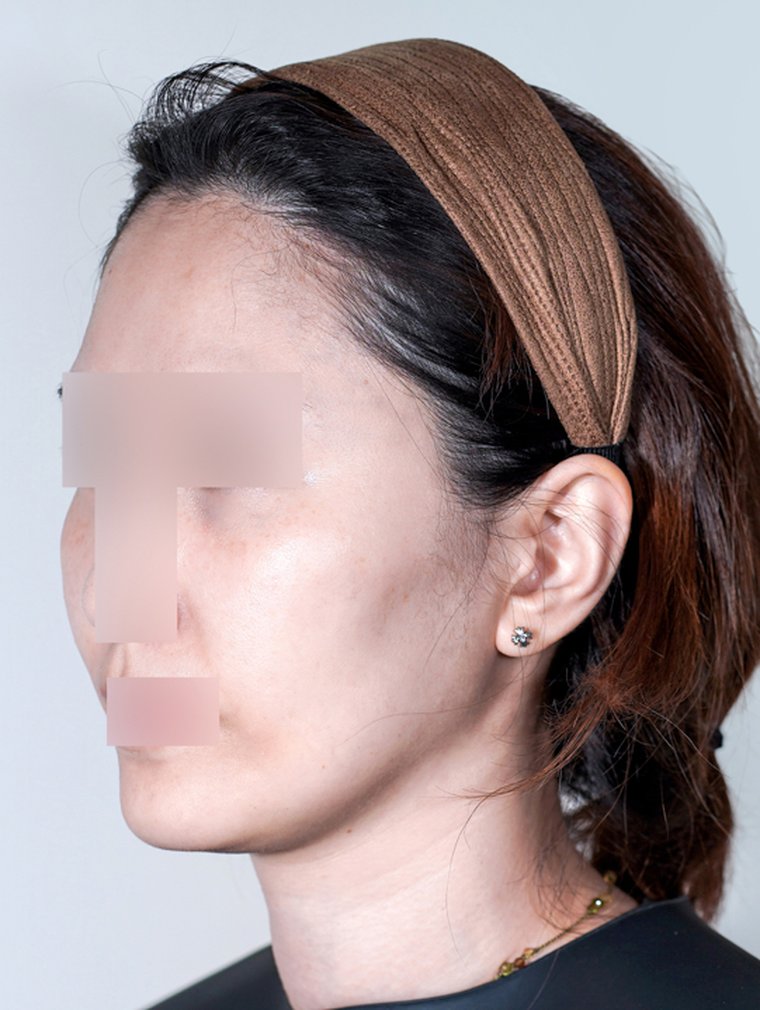 Sculptra at MILI Clinic Dosan — before, case 1