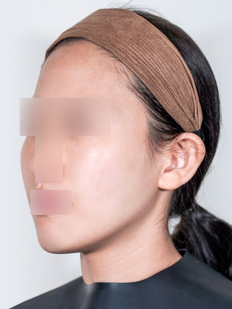 Sculptra at MILI Clinic Dosan — after, case 2
