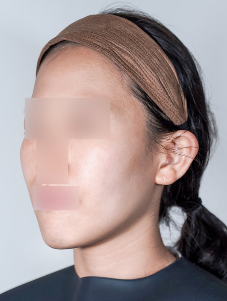 Sculptra at MILI Clinic Dosan — before, case 2