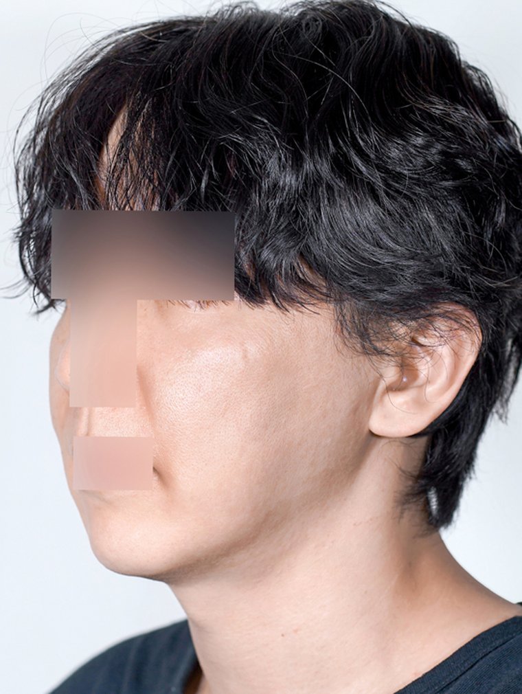 Thermage FLX before, MILI Clinic Dosan