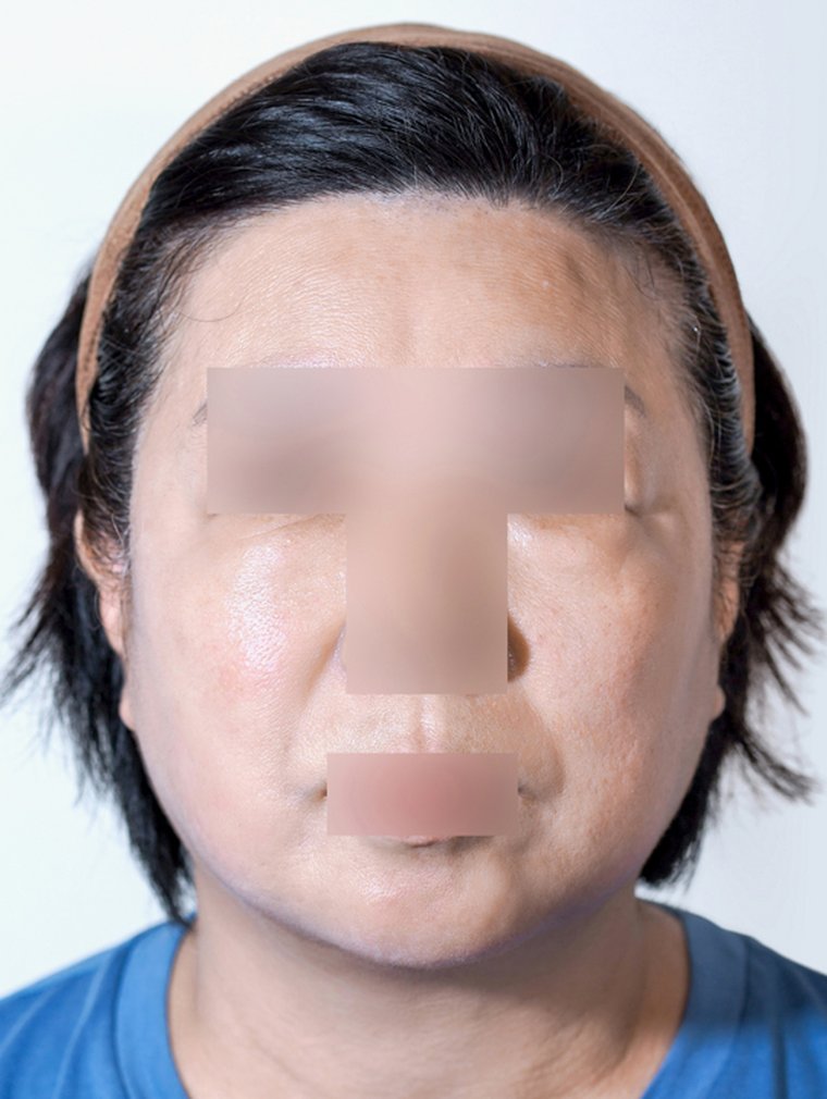 Silhouette Soft at MILI Clinic Dosan — after, case 1