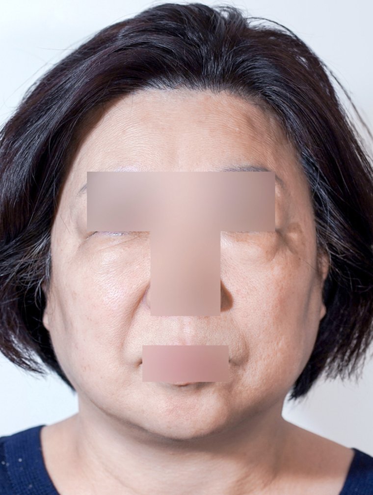 Silhouette Soft at MILI Clinic Dosan — before, case 1