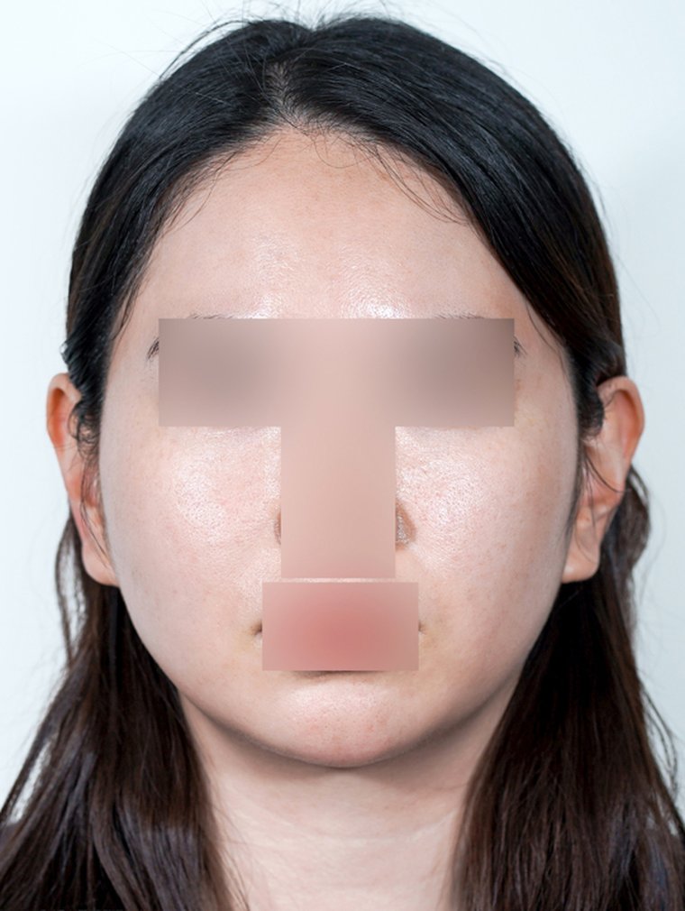 Silhouette Soft at MILI Clinic Dosan — after, case 2