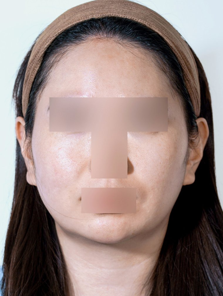 Silhouette Soft at MILI Clinic Dosan — before, case 2