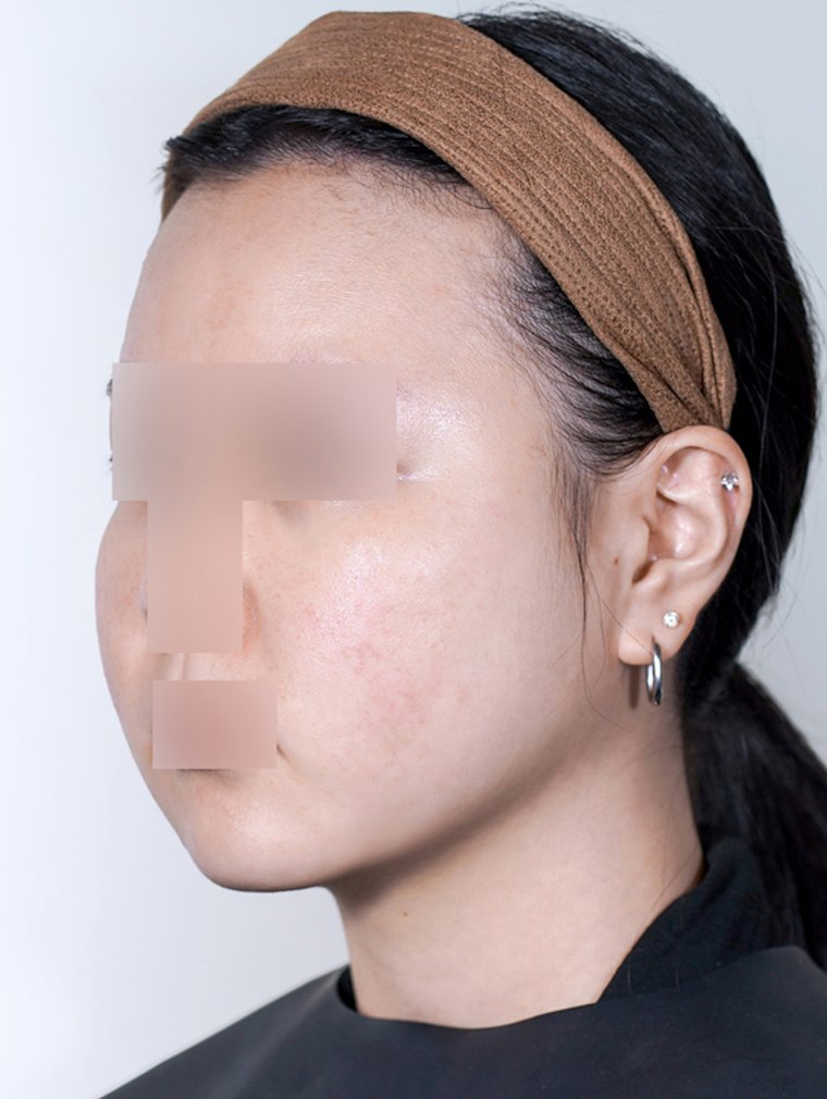 Tuneface at MILI Clinic Dosan — after, case 1