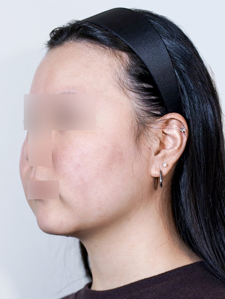 Tuneface at MILI Clinic Dosan — before, case 1