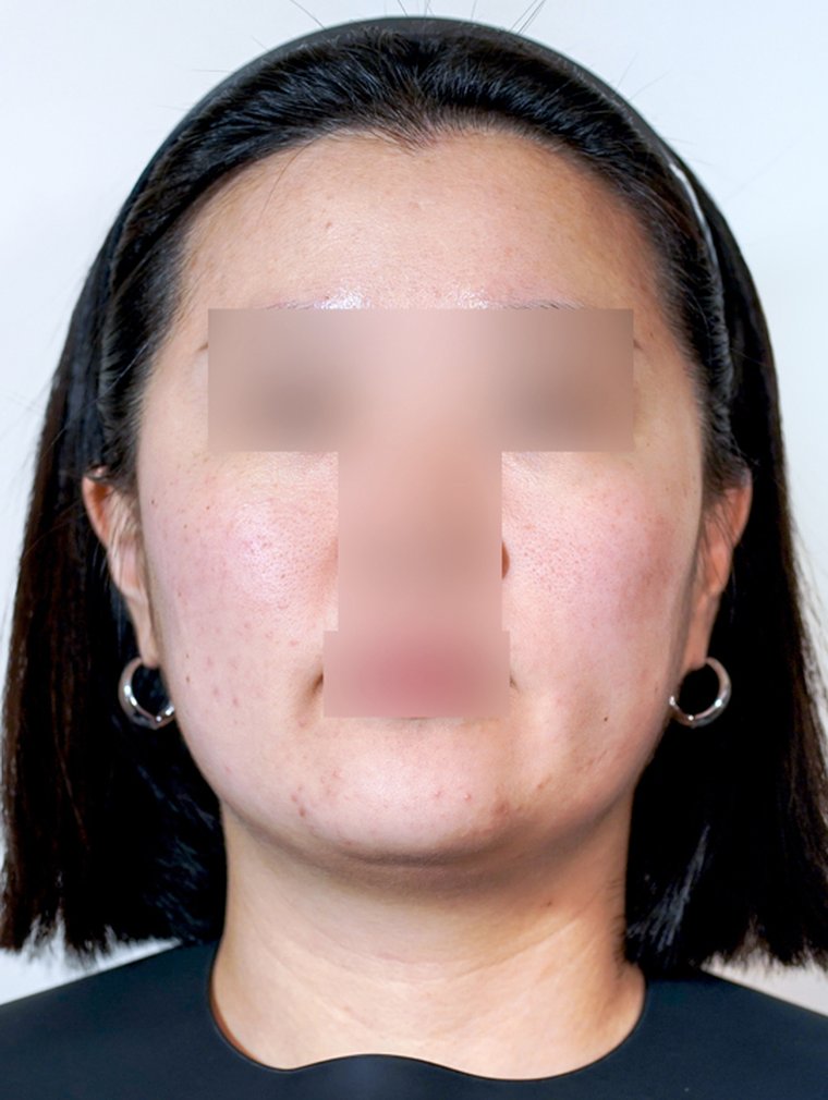 Ultherapy Prime before, MILI Clinic Dosan
